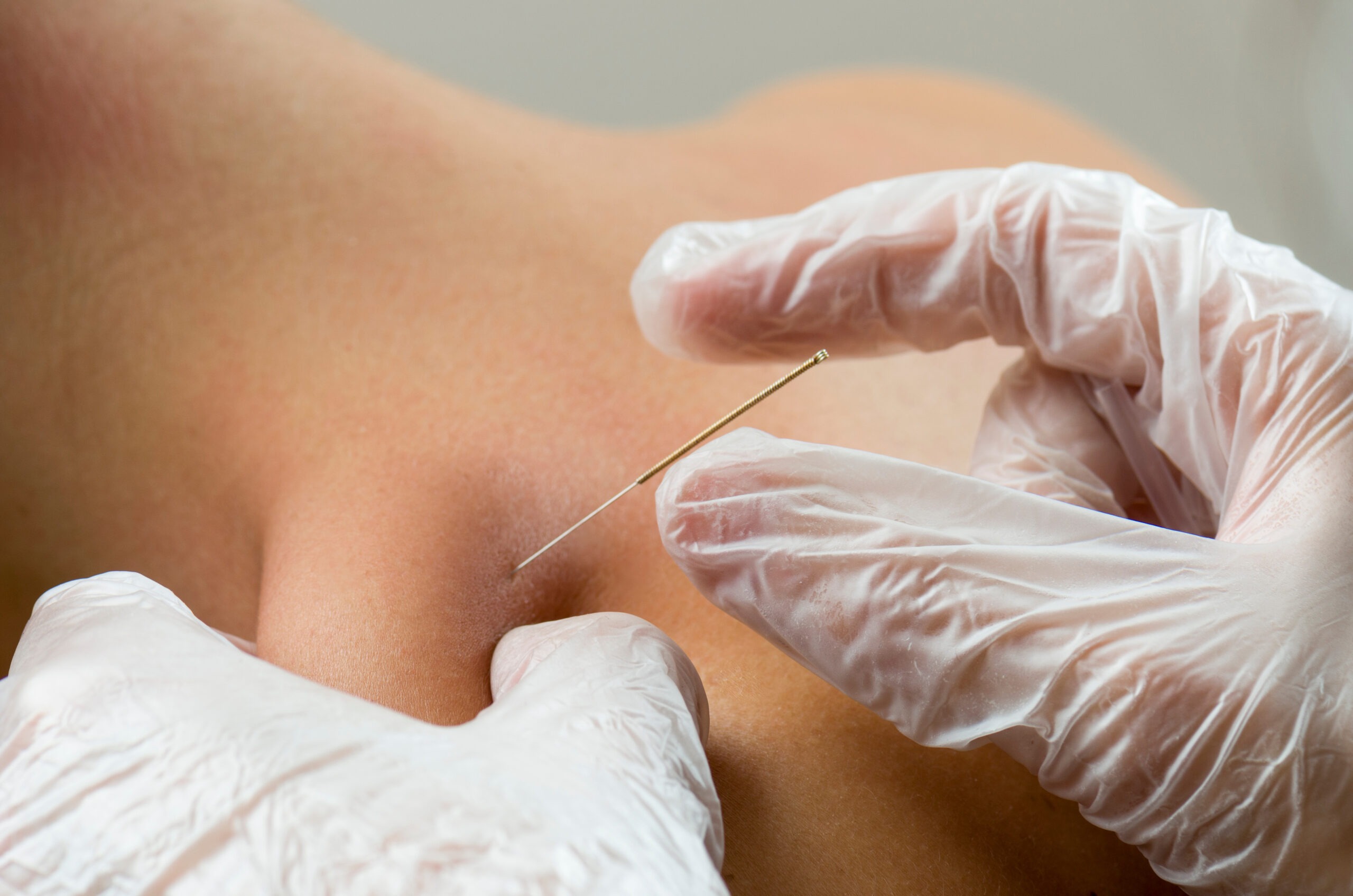 Diploma in Dry Needling (D.Dr.N)